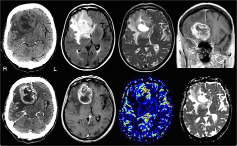 Cat Scan Brain Tumor