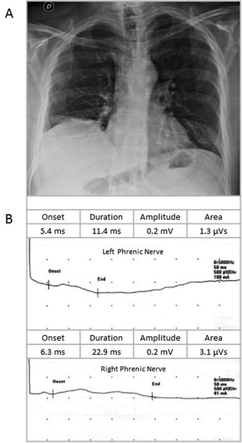 A) Chest X-ray showing right hemidiaphragm elevation. B)... | Download ...