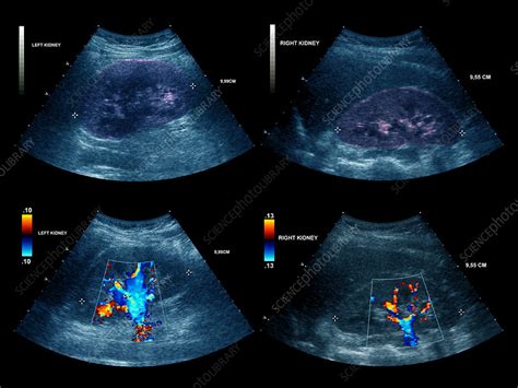 Healthy kidneys, ultrasound scan - Stock Image - P550/0254 - Science ...