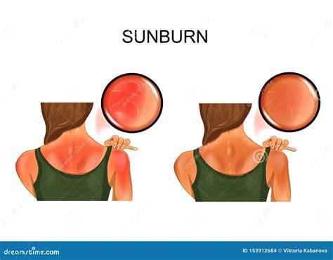 Sunburn Cartoons, Illustrations & Vector Stock Images - 7223 Pictures ...