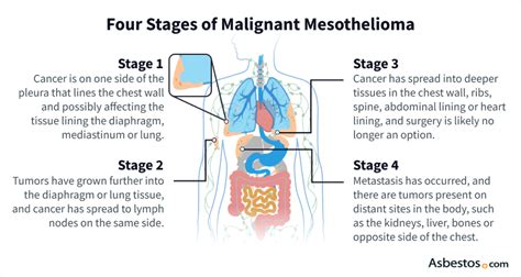 Mesothelioma Overview: Symptoms, Diagnosis & Treatment