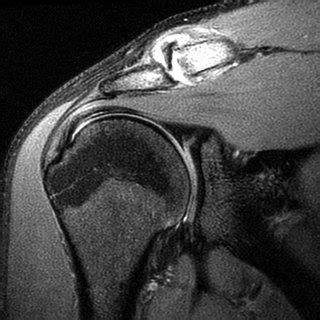 Arthrogram procedure. Anterior approach of needle for image-guided ...