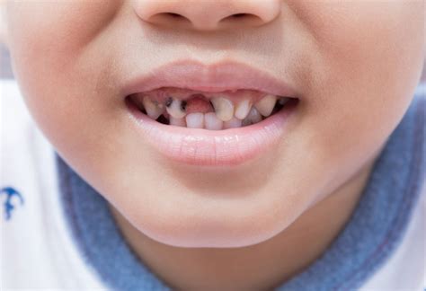 Fighting Tooth Decay in Children - | Best Dental Care for Kids