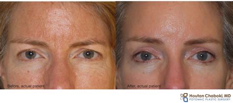 Brow vs bleph? Lift the brow and/or the upper eyelid with plastic surgery – Potomac Plastic Surgery