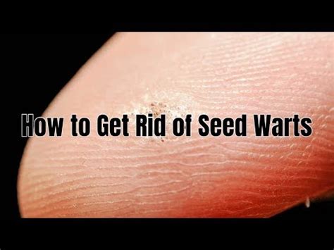 How to Get Rid of Seed Warts - YouTube