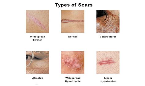 How to Get Rid of Scars - Skin Beauty