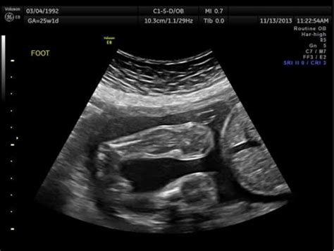 Figure 4 from Congenital Talipes Equinovarus : A Case Report Of Bilateral Clubfoot In Three ...