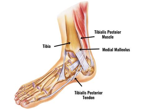 Posterior Tibial Tendon Dysfunction (PTTD) - Symptoms, Treatment