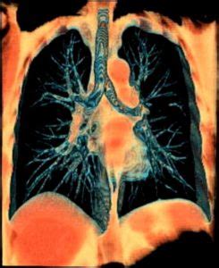 Trees in the Lungs | Medical Art