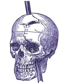 Skull of Phineas Gage and the Rod That Passed Through It, Boston, Massachusetts