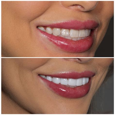 Porcelain Veneers Brisbane [Free Consult] | Smiling Dental