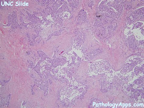 salivary duct carcinoma pathology