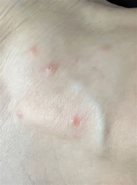 Chigger Bites Vs Bed Bug Bites