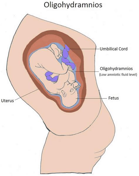 Oligohydramnios definition, causes, symptoms, diagnosis & treatment