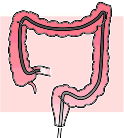 Coloscopy | definition of coloscopy by Medical dictionary