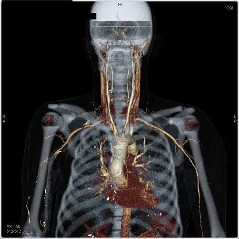 Normal CTA of the Neck - Neuro Case Studies - CTisus CT Scanning