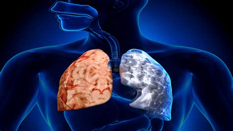 Chronic Obstructive Pulmonary Disease (COPD)| Interactive Health