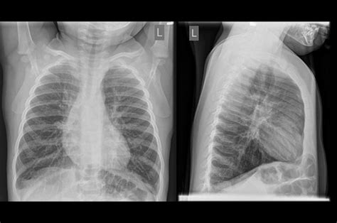 Chest X Ray Bronchitis Vs Pneumonia