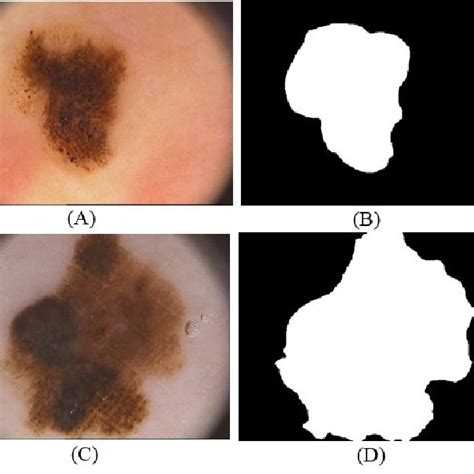 Different types of dermoscopy images for both type benign and melanoma;... | Download Scientific ...