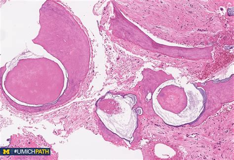 Odontoma Pathology