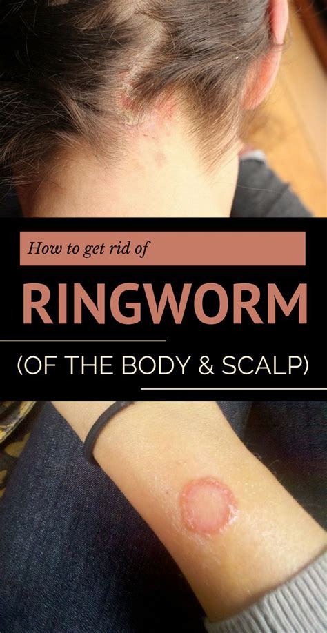 How to Get Rid of Ringworm (of the Body and Scalp) | Get rid of ringworm, Ringworm, Ringworm ...