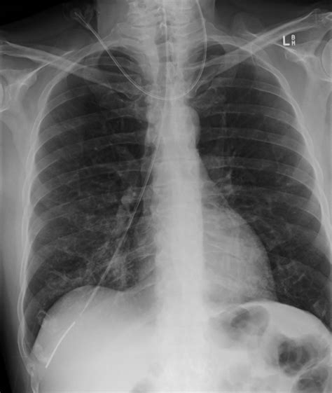 Malpositioned Nasogastric Tube in Right Main Bronchus