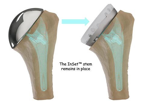 Total Shoulder Replacement Surgery - Shoulder Innovations