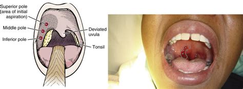 Peritonsillar Abscess | Radiology Key