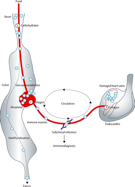 The itinerary of Streptococcus gallolyticus infection in patients with colonic malignant disease ...