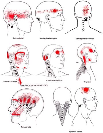 HEADACHES… THE CAUSES & THE ROLE OF MYOTHERAPY IN BEATING THEM!! » Northern Podiatry