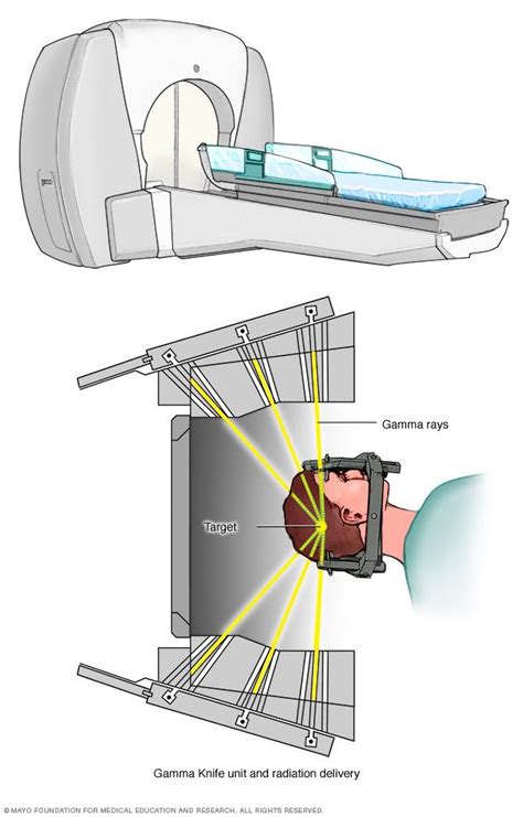 Brain Surgery, Brain Tumor, Tumor Cerebral, Facial Nerve, Cerebrospinal ...