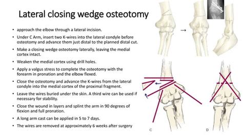 Cubitus valgus varus | PPT