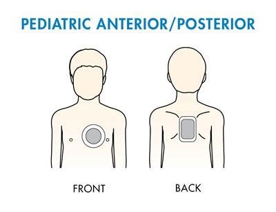 aed pad placement anteroposterior