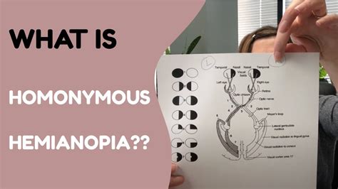 What is Homonymous Hemianopia? - YouTube