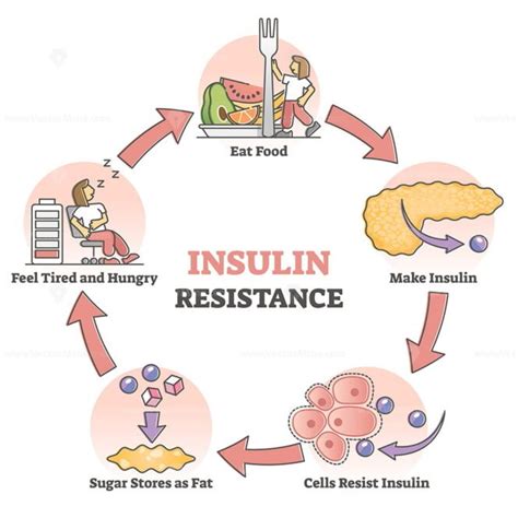 Insulin resistance pathological health condition educational outline diagram - VectorMine