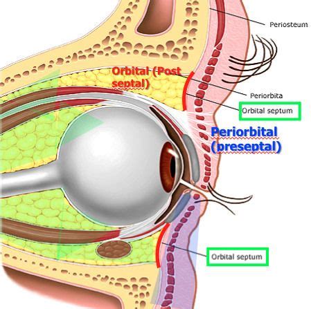 Pre-septal - superficial to orbital septum - vs. post-septal (orbital ...