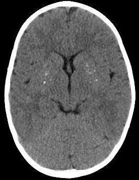 Brain Calcifications - SimulConsult