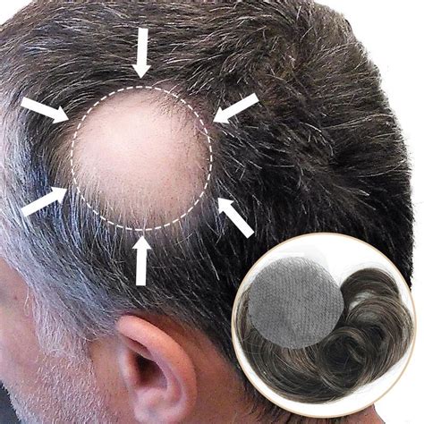 Side/Back Hair Patches for Men Covering Bald Spots - ReHair System