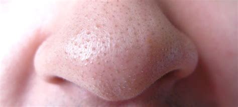 Home Remedies for Clogged Pores HowRid - 5925