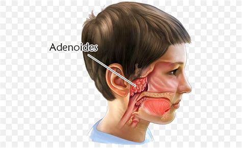 Adenoids Surgery