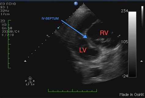 Right Heart Strain ~ Ultrasound Cases Info