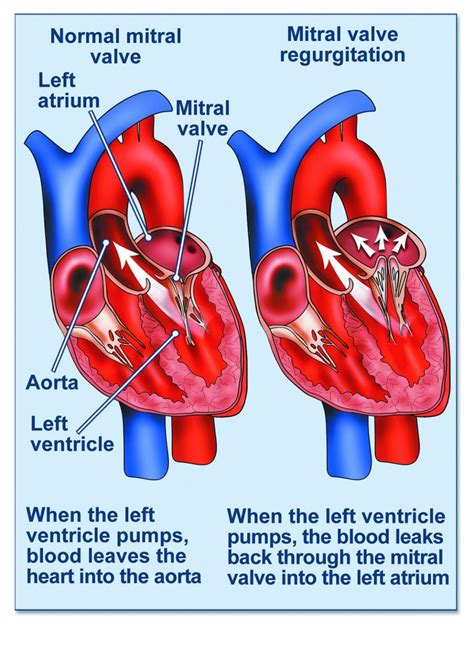 Mitral regurgitation - British Heart Valve Society