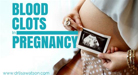 Blood Clots in Pregnancy | Dr. Lisa Watson