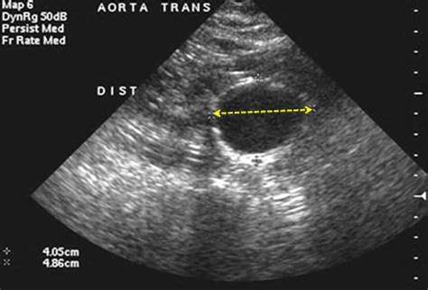 Ultrasound Assessment of Abdominal Aortic Aneurysms