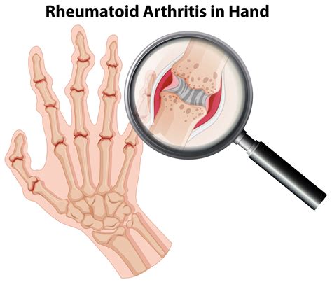 Human anatomy rheumatoid arthritis in hand 418598 Vector Art at Vecteezy