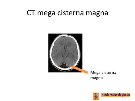 Cisterna Magna Meaning Youtube