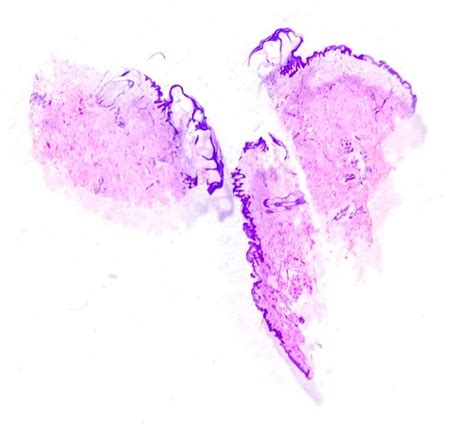 Types of Skin Biopsy