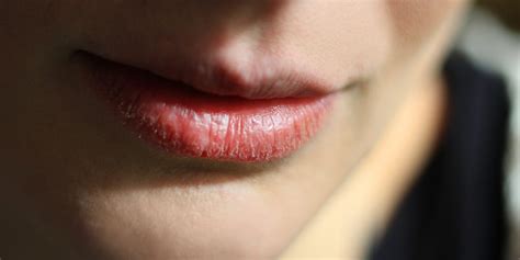 Dry Itchy Rash On Lips | Lipstutorial.org