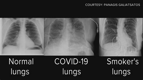 Unhealthy Healthy Lungs Xray - bmp-park