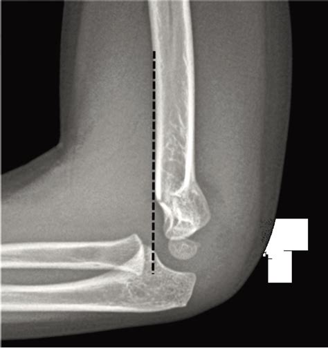 How to screen a paediatric elbow X-ray for injuries